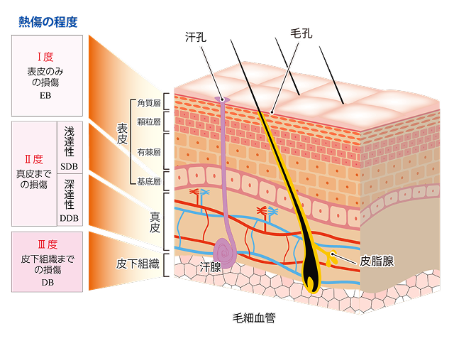熱傷の程度を表す図