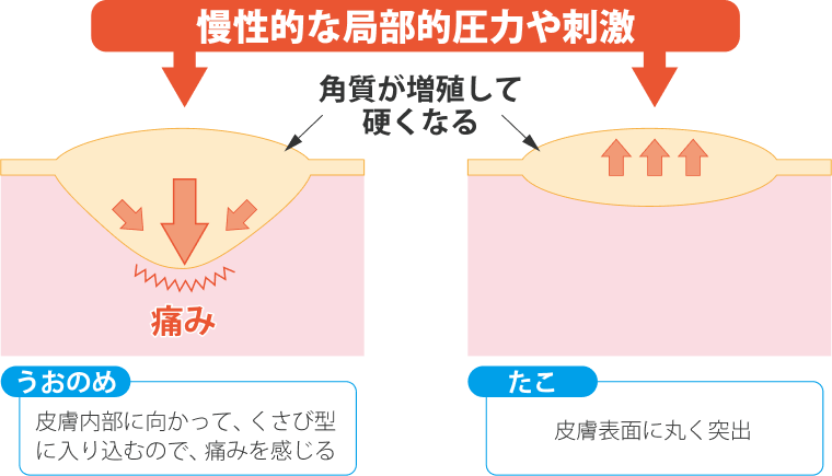 うおのめ：皮膚内部に向かって、苦ザビがたいん入り込むので痛みを感じる たこ：皮膚表面に丸く突出