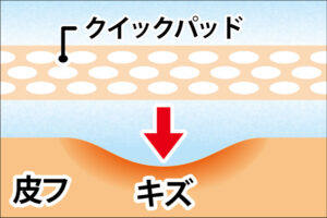 クイックパッドの湿潤療法（モイストヒーリング）とは
