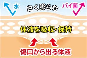 傷口から出る体液を吸収・保持することで自然治癒力を高める治療法です。