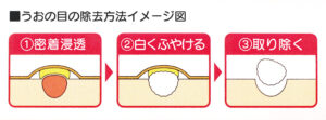 うおの目の除去方法イメージ図