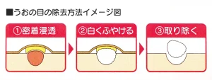 うおの目の除去方法イメージ図