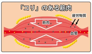 磁気バン説明図02　コリのある筋肉